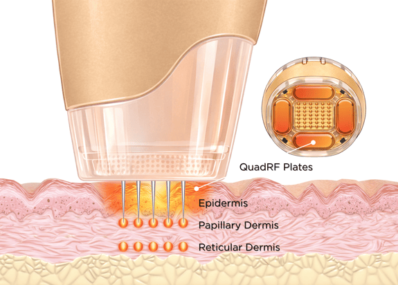 Dermal Layers illustration with QuadRF plates, epidermis, papillary and reticular-1