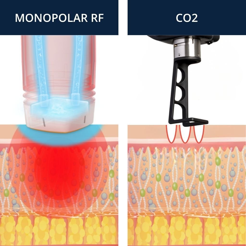 RadiantLift technology showing Monopolar RF and CO2 technology RadiantLift technology showing Monopolar RF and CO2 technology