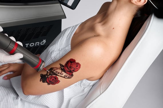patient getting tattoo removal via toro device
