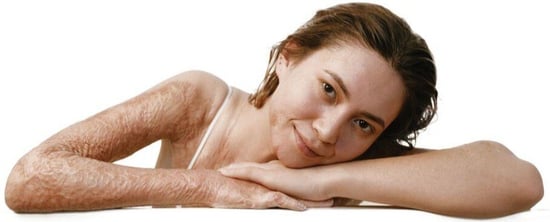 Woman smiling at camera, showcasing scar on right arm that is treated