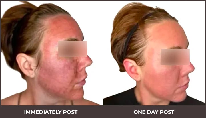 Female patient - before and after results of receiving Tetra CO2 and EXO CR
