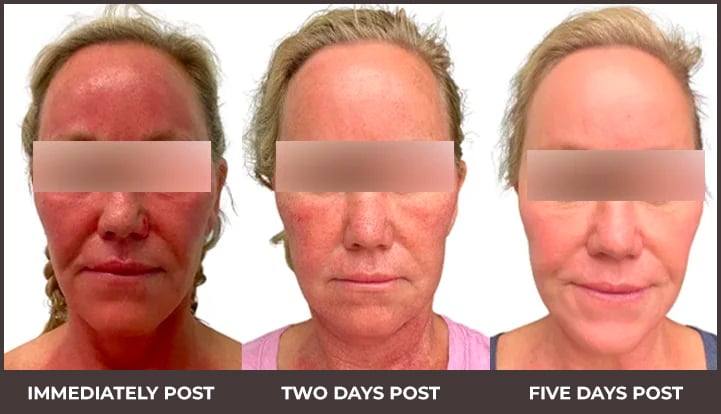 Results - Before and After - Female patient with Helix and EXO CR treatment