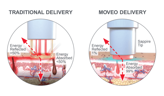 Traditional Delivery vs Moveo Delivery illustration, showing less energy reflected and more energy absorbed