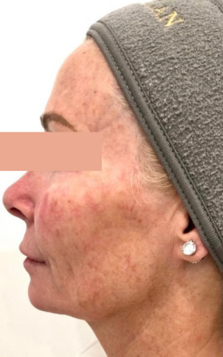CoolPeel before example for sun damage and cheek texture