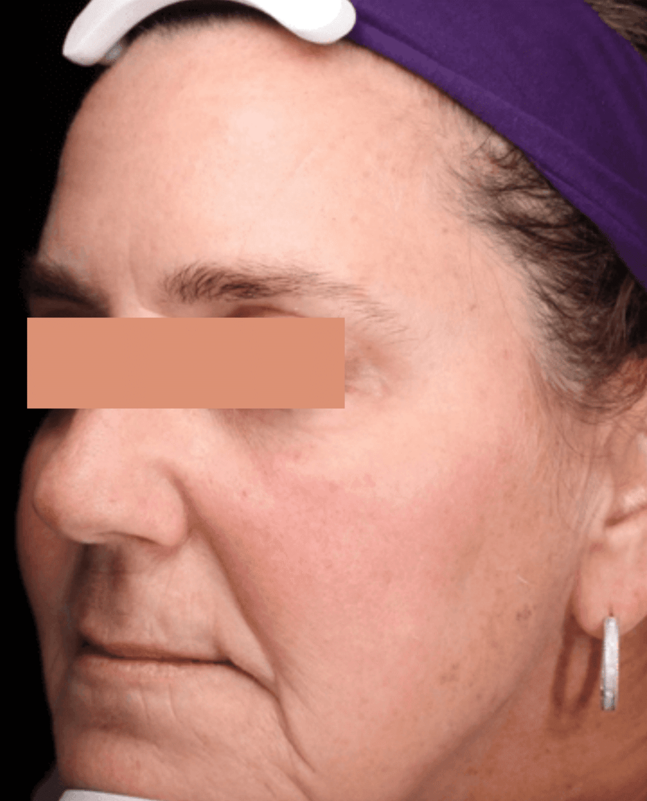 Angled view of middle aged womans face after MoveoGlo treatment