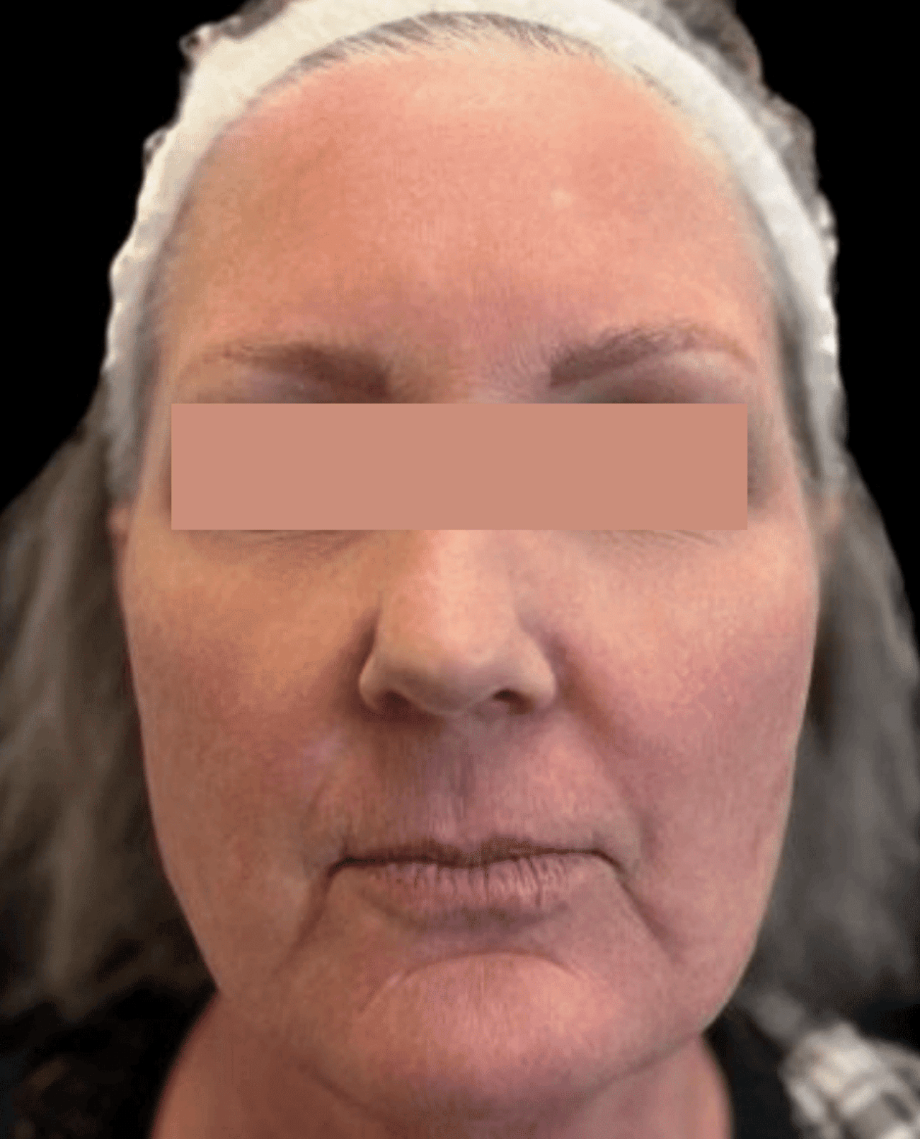 Front view of womans face after moveoglo treatment