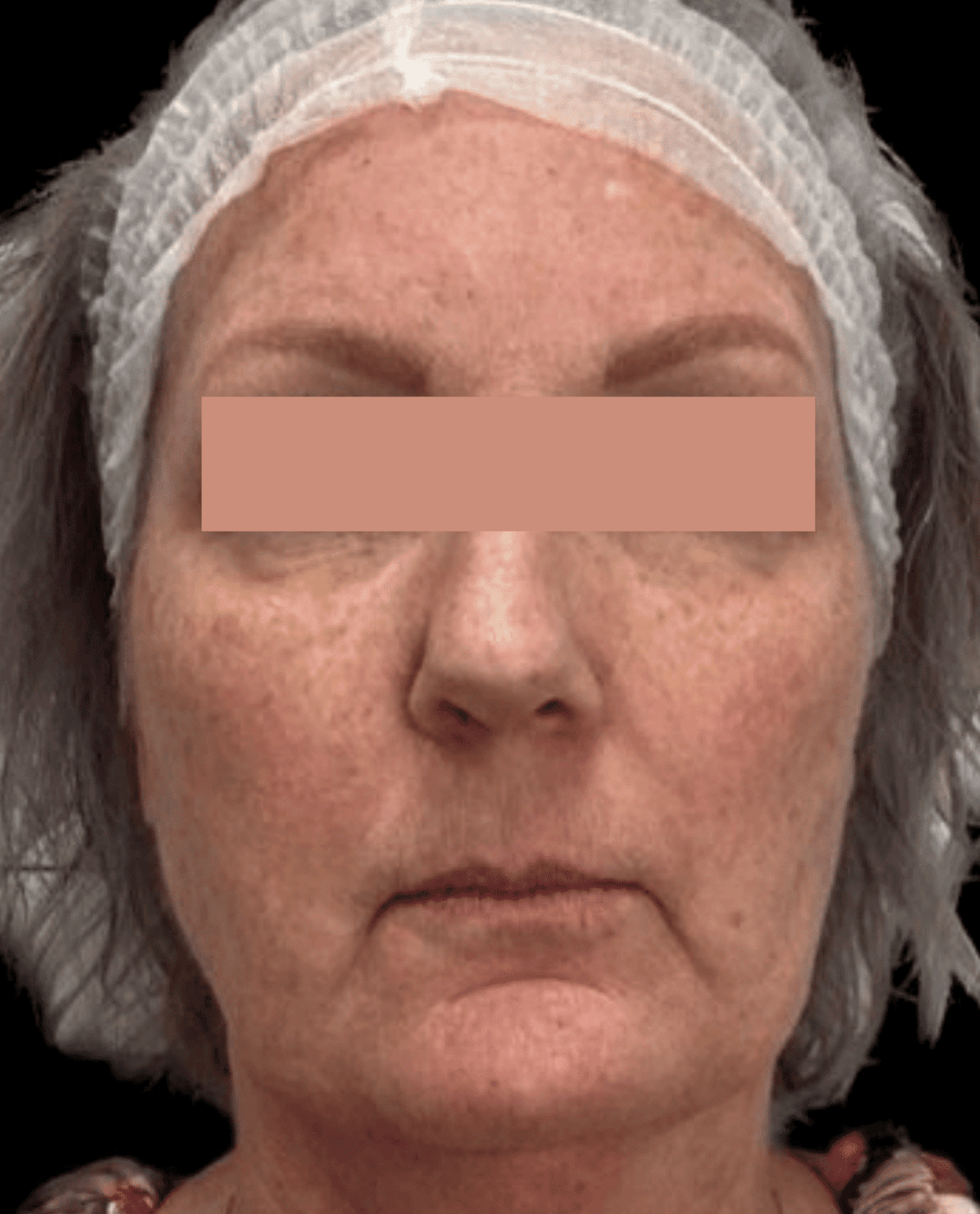 Front view of womans face before moveoglo treatment-1