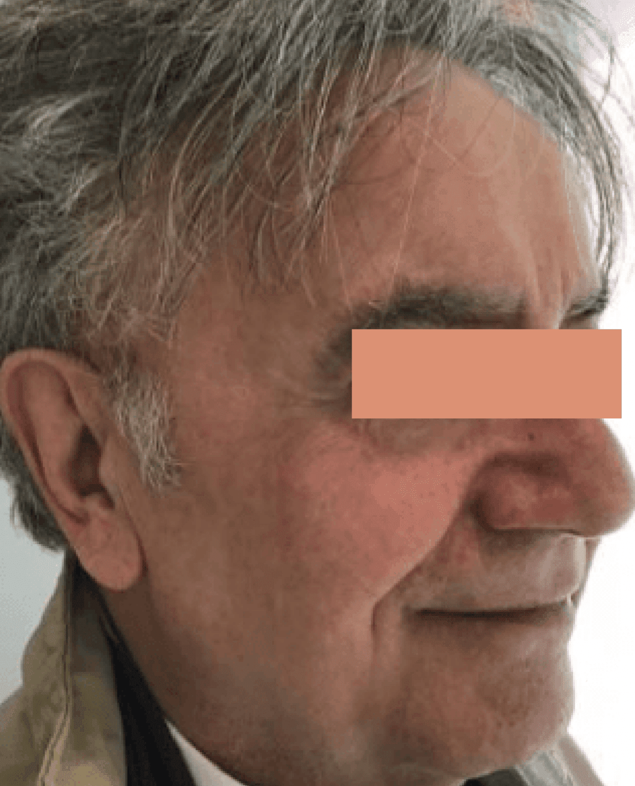 Side profile of mans face after moveoglo treatment
