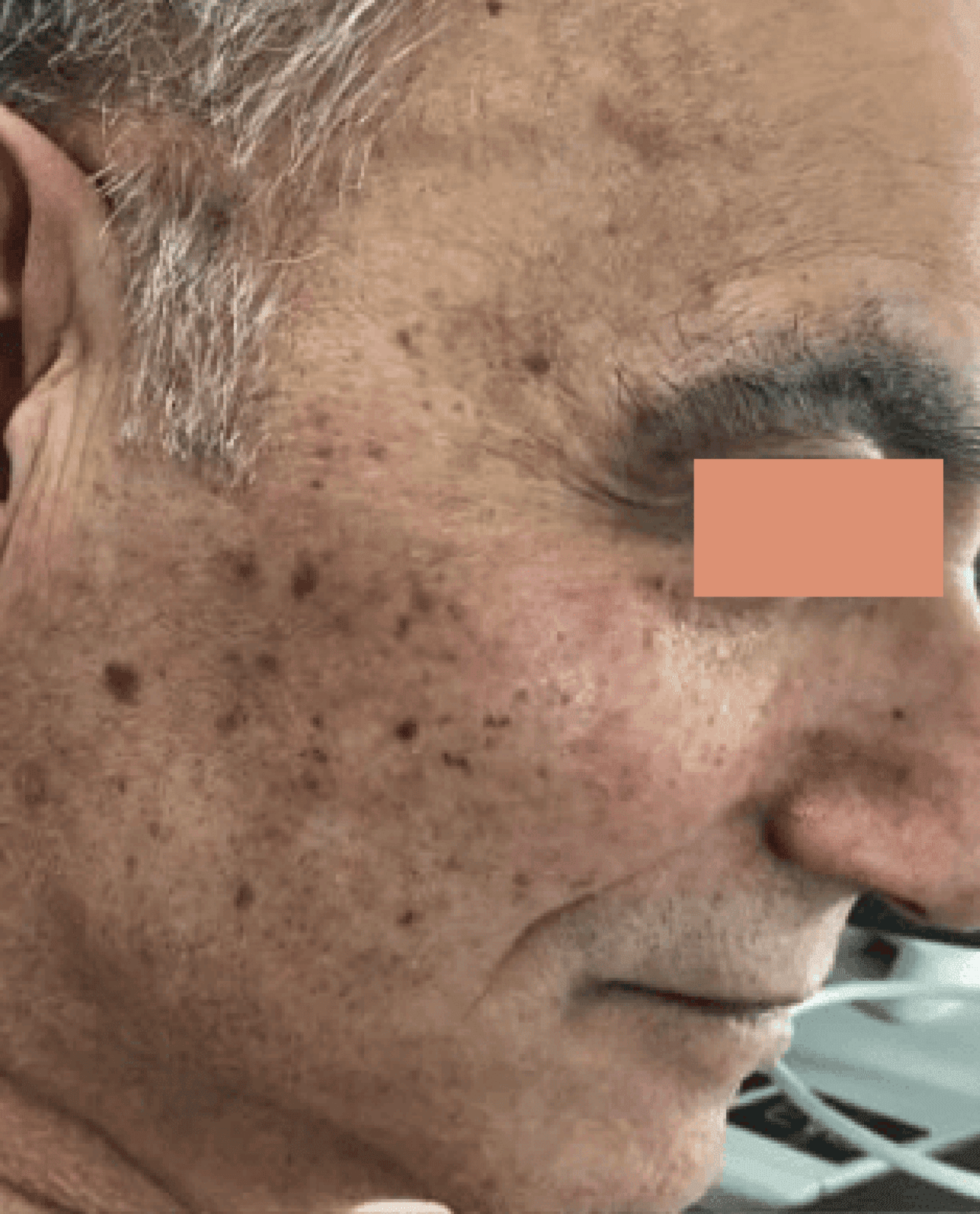Side profile of mans face before moveoglo treatment-1