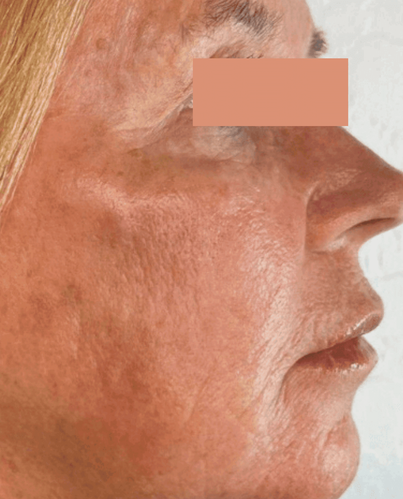 Side view of older womans face after MoveoGlo treatment