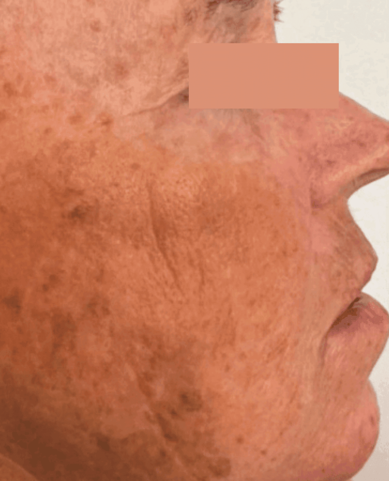 Side view of older womans face before MoveoGlo treatment-1