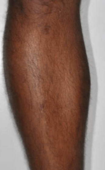 Before image of Motus AZ+ treatment on male leg hair