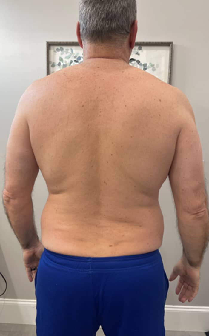 Mans back after Motus treatment