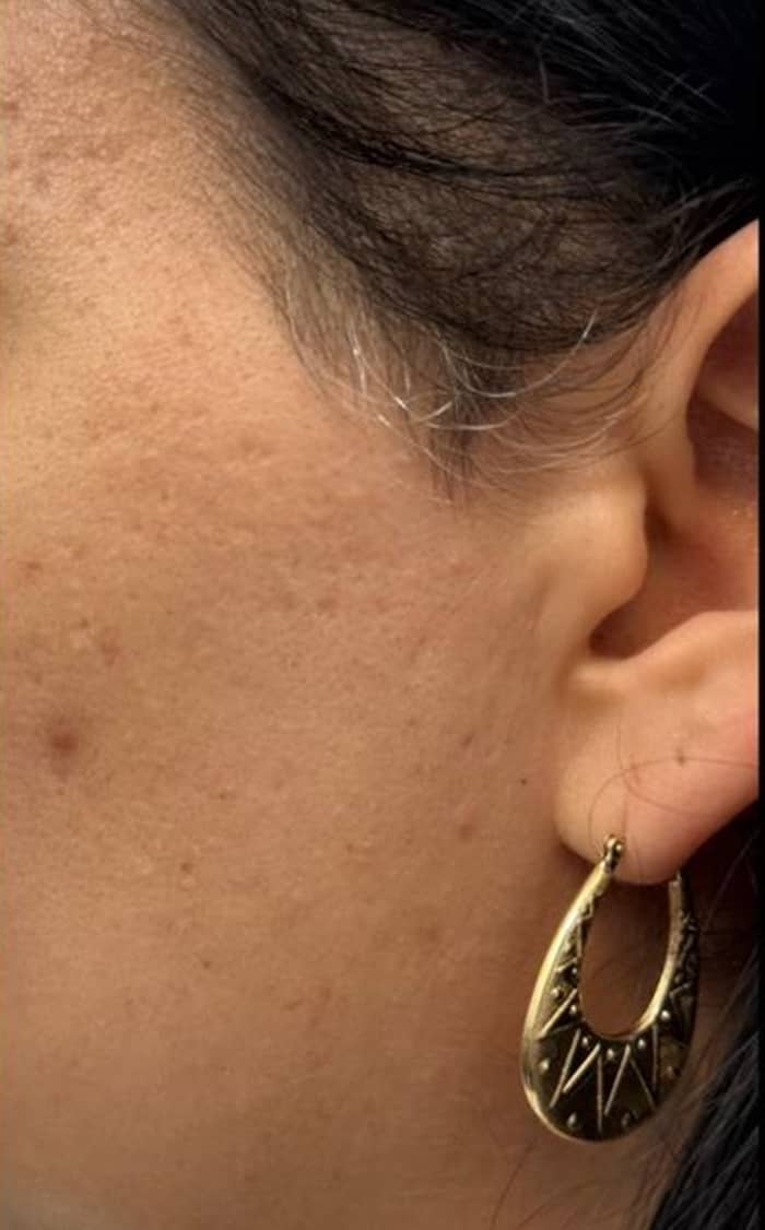 Womans side of face after Motus treatment