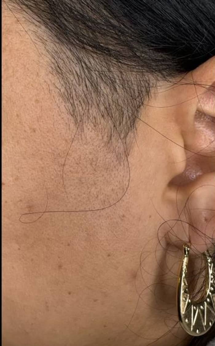 Womans side of face before Motus treatment