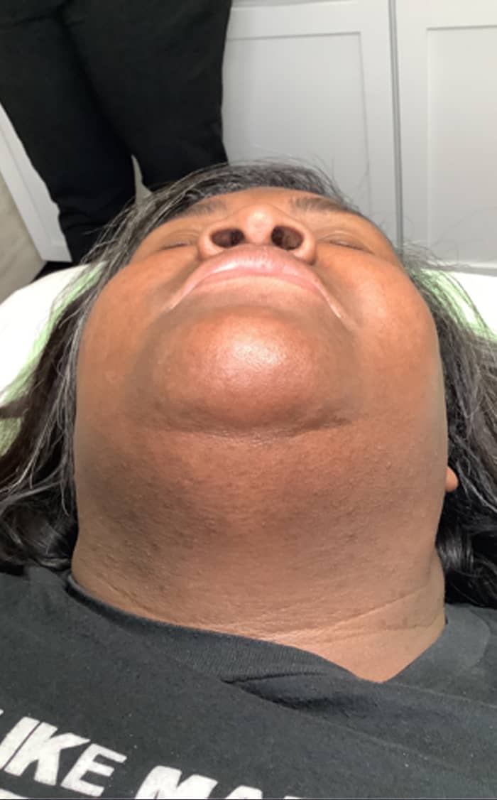 Womans under chin area after Motus treatment