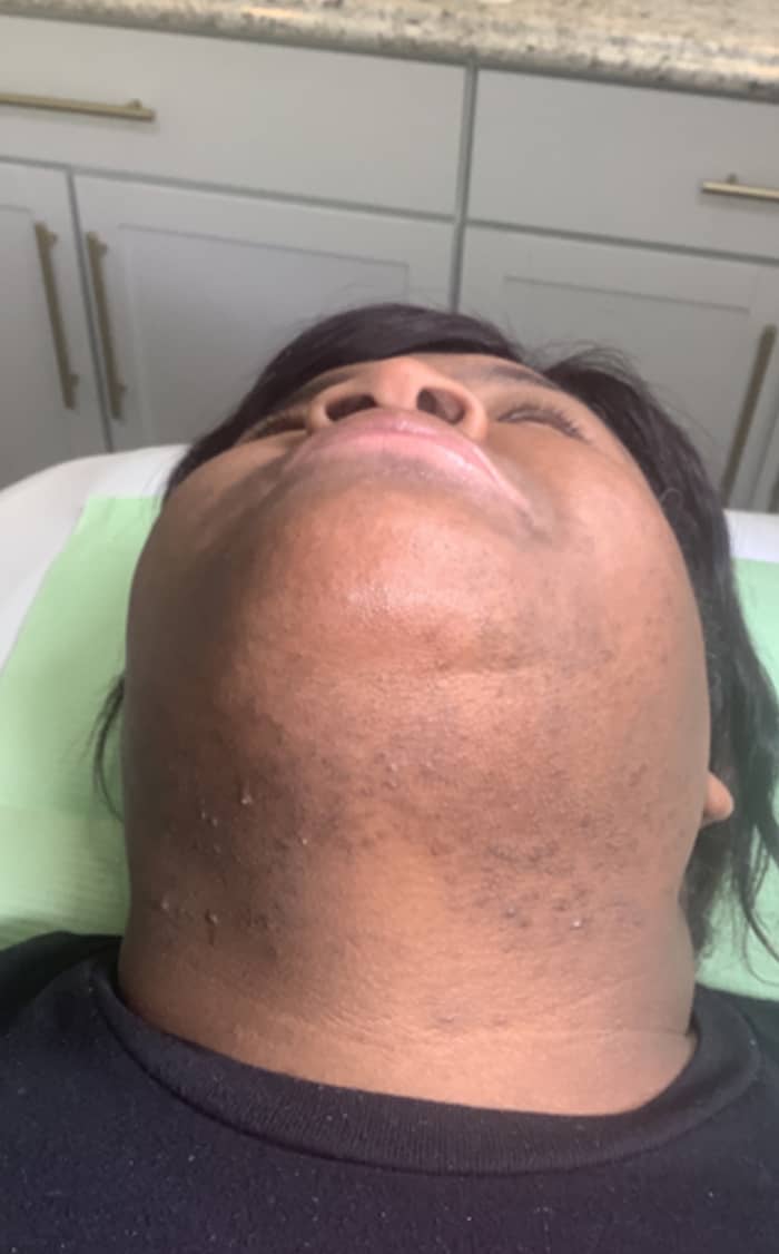 Womans under chin area before Motus treatment
