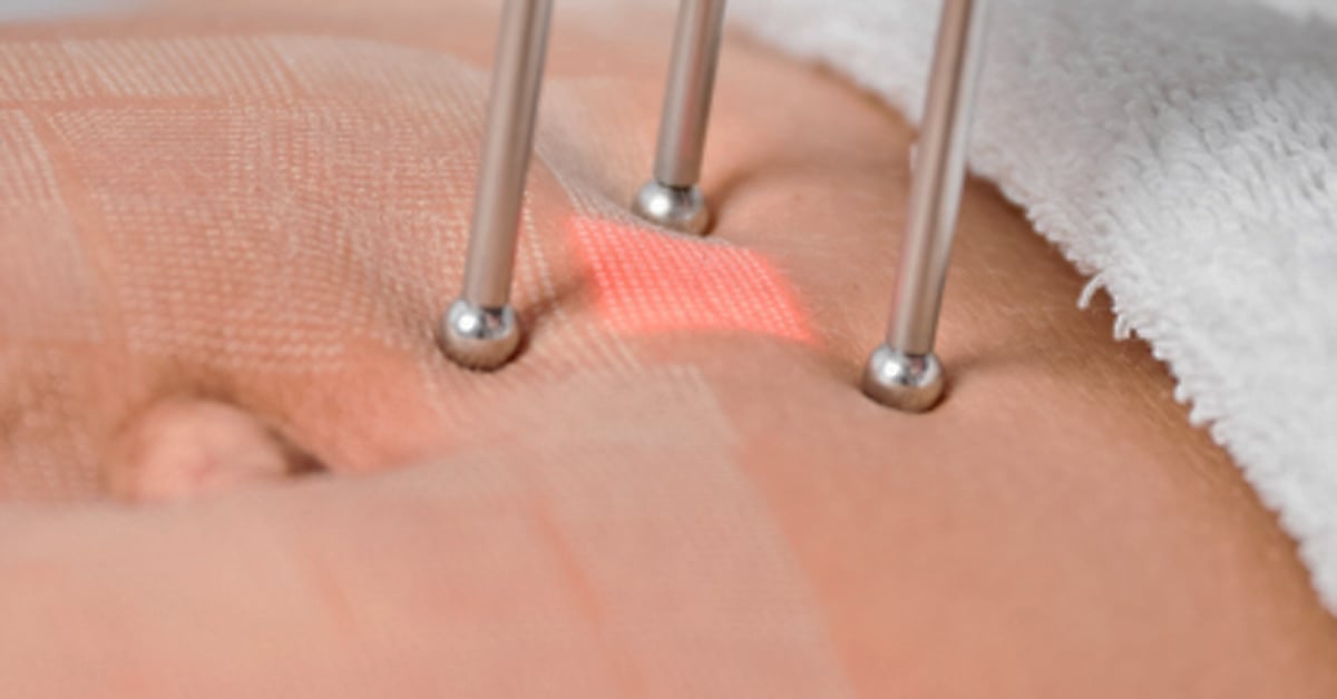 Close-up of laser resurfacing